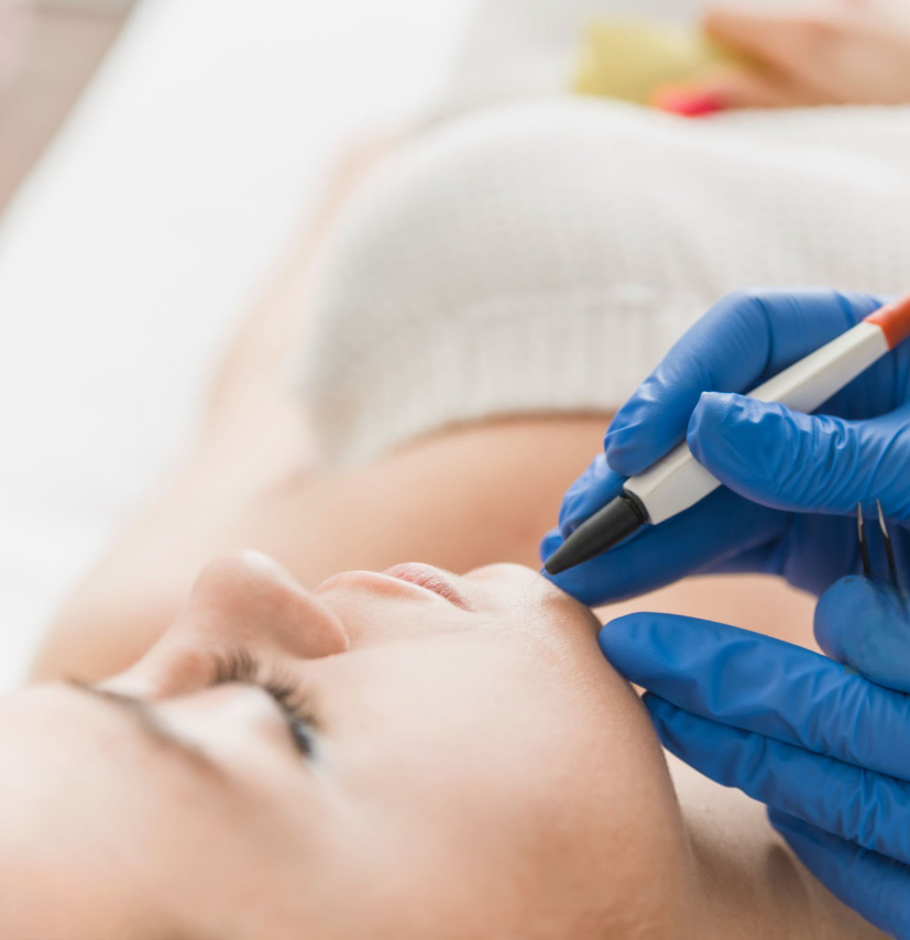 électrolyse menton visage avant après électrolyse menton visage avant après